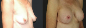 Patient 2.2 Before and After Breast Lift