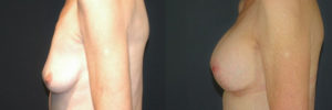 Patient 2.3 Before and After Breast Lift