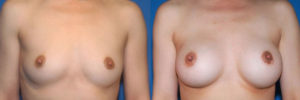 Patient 3 Before and After Breast Augmentation