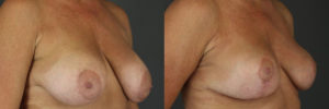 Patient 3.1 Before & After Breast Reduction