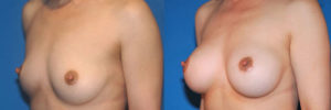 Patient 3.1 Before and After Breast Augmentation