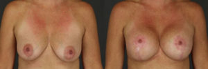 Patient 3.1 Before and After Breast Lift