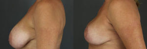 Patient 3.2 Before & After Breast Reduction