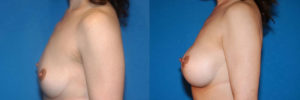 Patient 3.2 Before and After Breast Augmentation