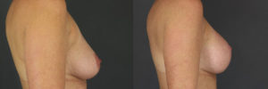 Patient 3.3 Before and After Breast Lift
