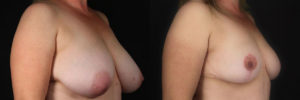Patient 4.1 Before & After Breast Reduction