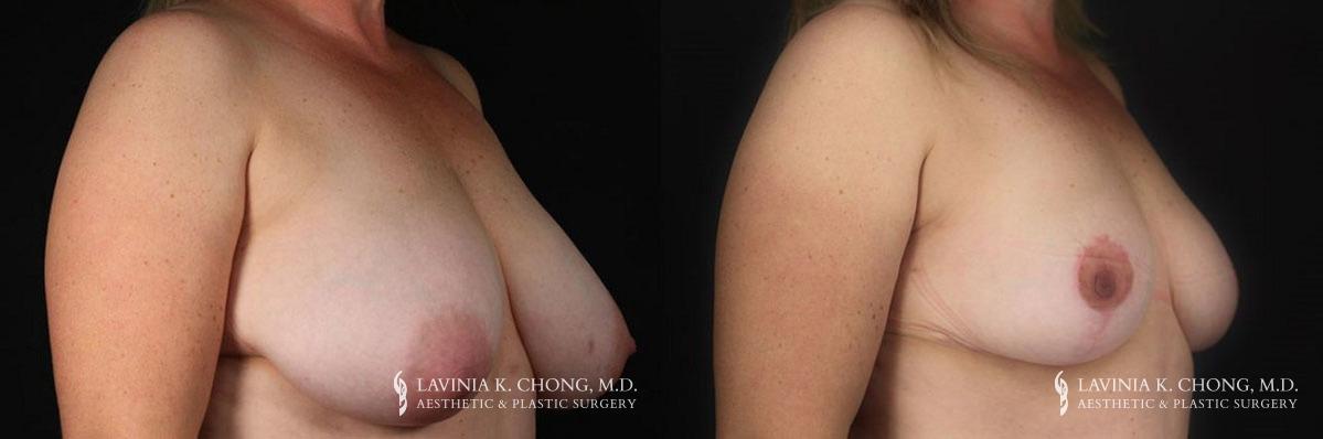 Patient 4.1 Before & After Breast Reduction