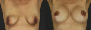 Patient 4.1 Before and After Breast Lift