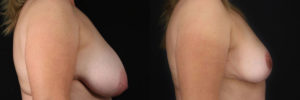Patient 4.2 Before & After Breast Reduction