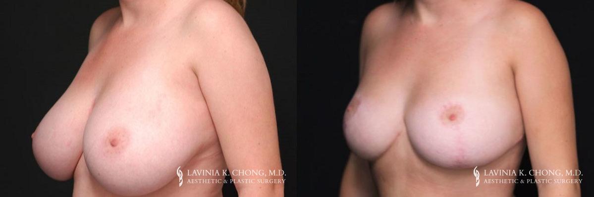 Patient 5.1 Before & After Breast Reduction