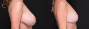 Patient 5.2 Before & After Breast Reduction
