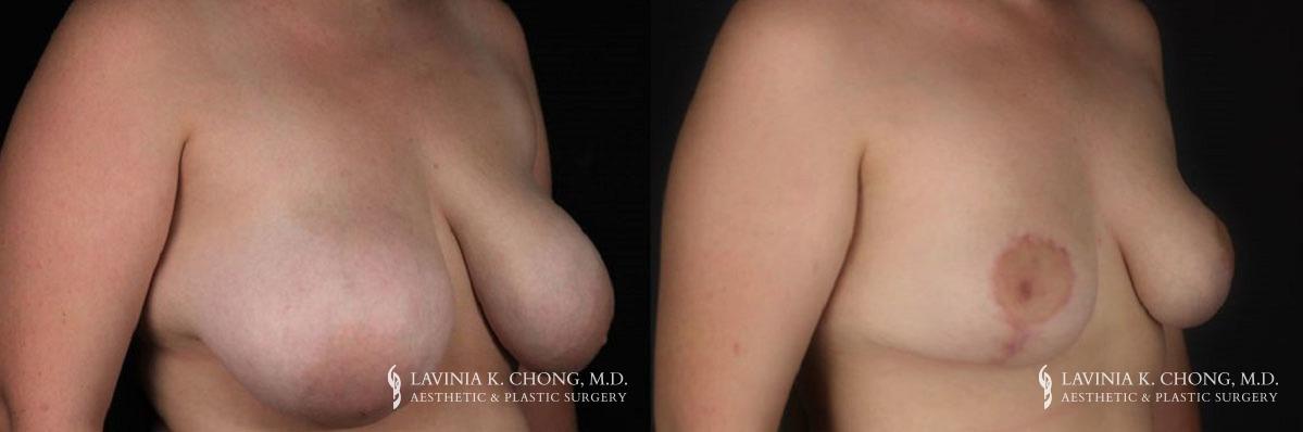Patient 6.1 Before & After Breast Reduction