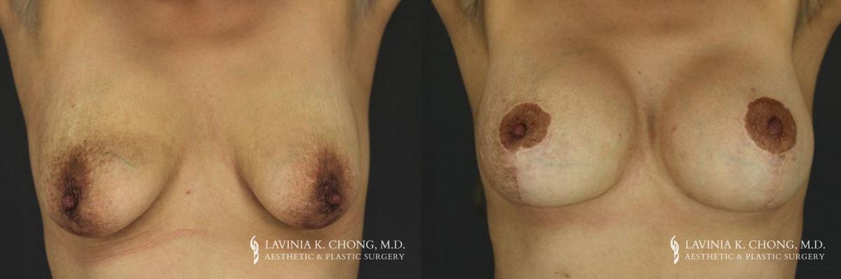 Patient 6.1 Before and After Breast Augmentation