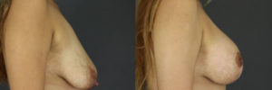 Patient 6.3 Before and After Breast Augmentation