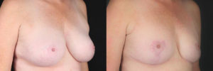 dr-chong-newport-beach-breast-reduction-patient-2-1