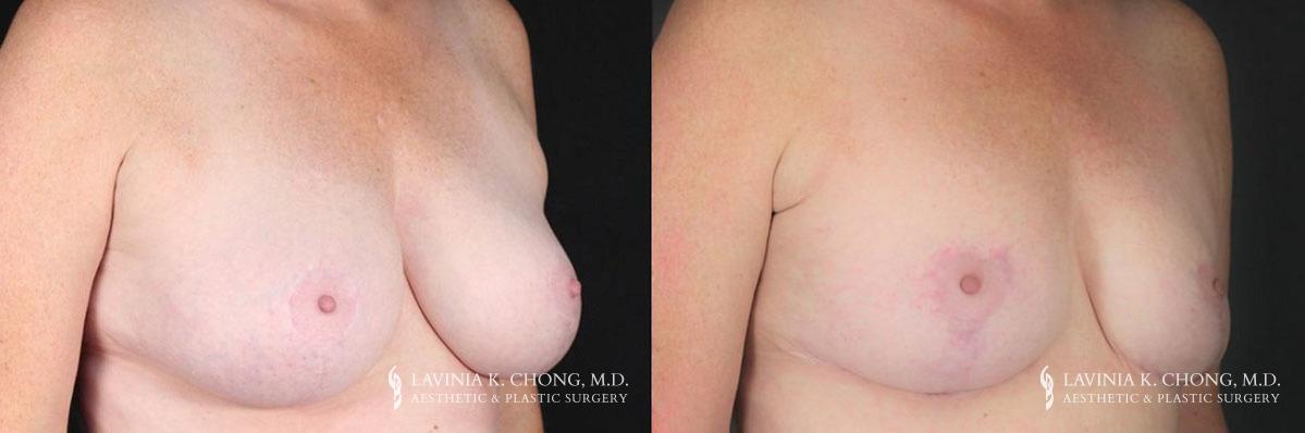 dr-chong-newport-beach-breast-reduction-patient-2-1