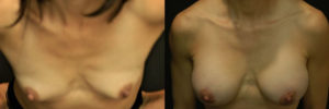 Patient 7.1 Before and After Breast Augmentation