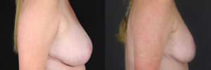 Patient 7.2 Before & After Breast Reduction