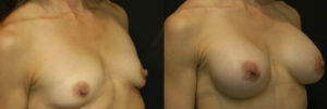 Patient 7.2 Before and After Breast Augmentation