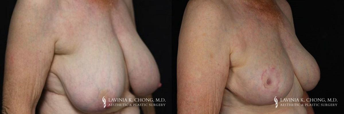Patient 8.1 Before & After Breast Reduction