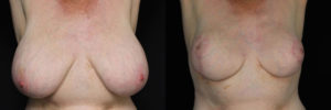Patient 8.2 Before & After Breast Reduction