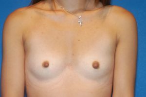 Internal Patient 10 Before Breast Augmentation Front View