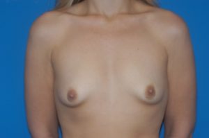 Internal Patient 11 Before Breast Augmentation Front View