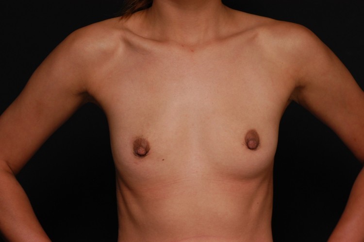 Internal Patient 12 Before Breast Augmentation Front View