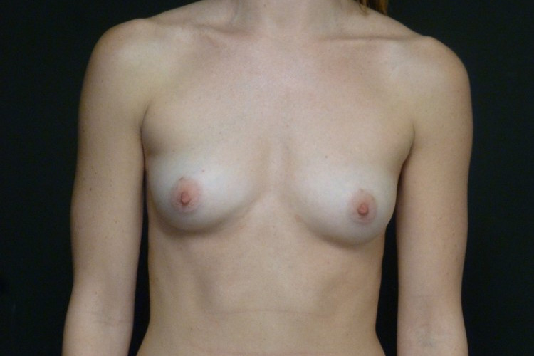 Internal Patient 7 After Breast Augmentation Front View Crop