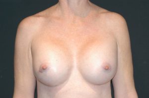 Internal Patient 5 After Breast Augmentation Front View