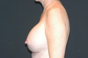 Internal Patient 5 After Breast Augmentation Side View