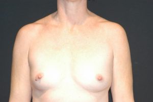 Internal Patient 5 Before Breast Augmentation Front View