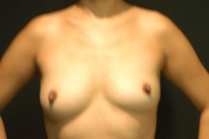 Internal Patient 6 Before Breast Augmentation Front View