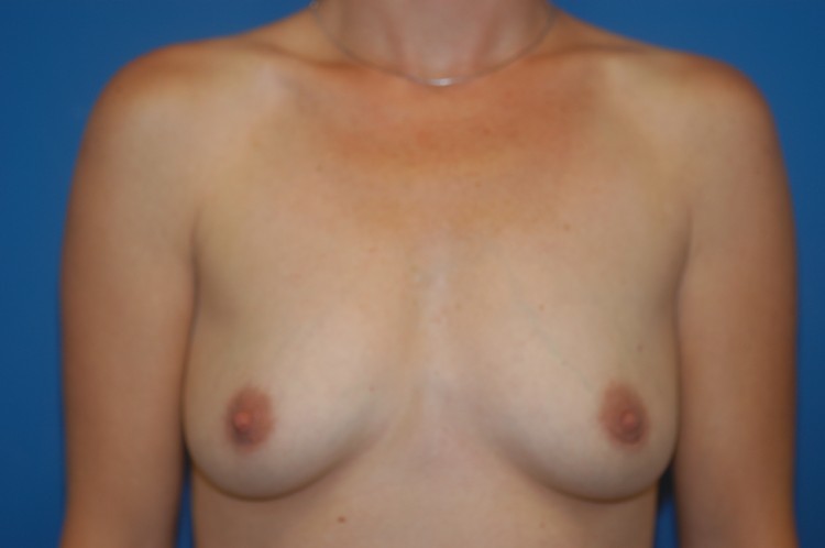 Internal Patient 8 Before Breast Augmentation Front View