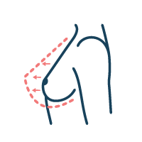 Icon of congenital hypomastia