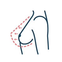 Icon of congenital hypomastia | lavinia k chong m D