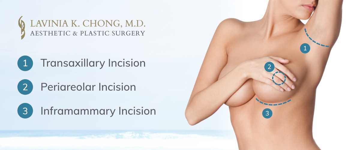 Breast augmentation incision types
