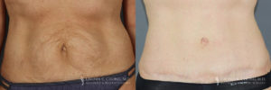 Abdominoplasty Patient 7065 Before & After A-1