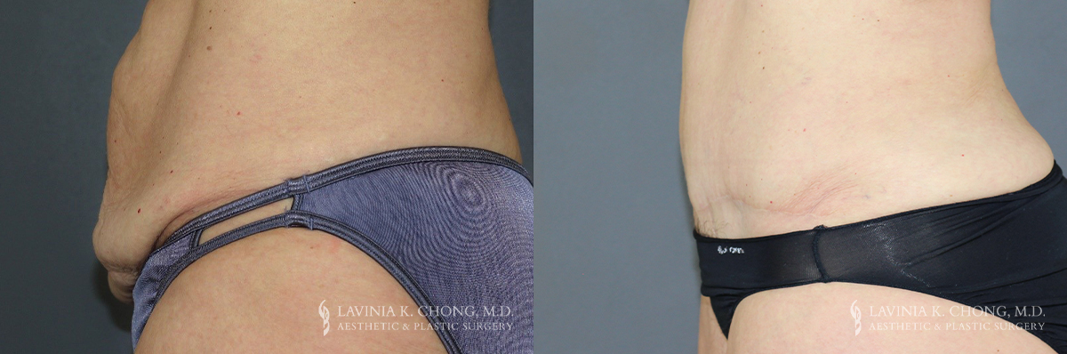 Abdominoplasty Patient 7065 Before & After B-1