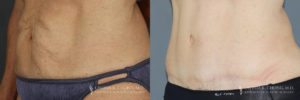 Abdominoplasty Patient 7065 Before & After C-1