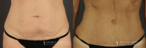 Abdominoplasty Patient 6597 Before & After A