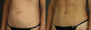 Abdominoplasty Patient 6597 Before & After B