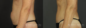 Abdominoplasty Patient 6597 Before & After C