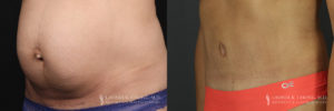 Abdominoplasty Patient 6173 Before & After A