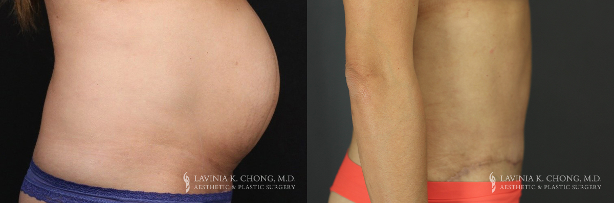 Abdominoplasty Patient 6173 Before & After B