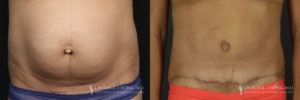 Abdominoplasty Patient 6173 Before & After C