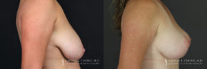 Breast Lift Patient 6 Before & After A