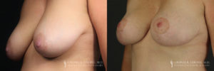 Breast Lift Patient 6 Before & After C