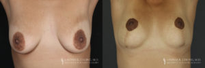 Breast Lift Patient 7 Before & After A