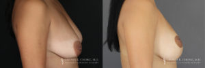 Breast Lift Patient 7 Before & After B